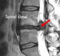 MRI scan showing herniated disc compressing spinal canal - Peoria IL chiropractic treatment