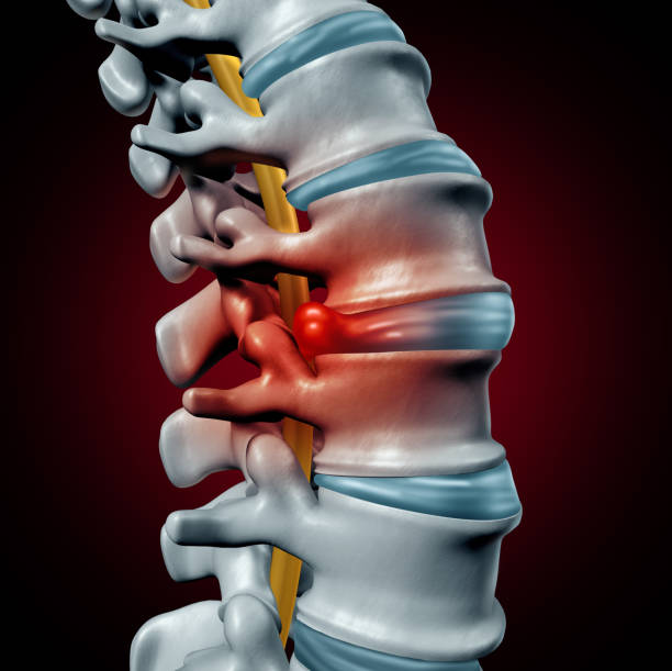 3D illustration of herniated disc and spinal compression - conditions treated with decompression therapy in Peoria IL